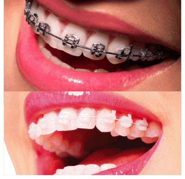 Aparelho convencional e estético Aparelho convencional e estético